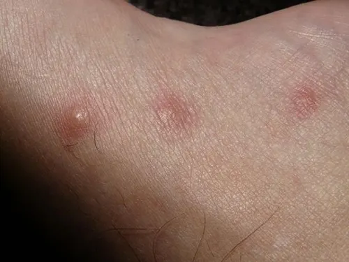 Picadura de pulga en humanos